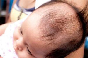 hết cứt trâu sau 5 ngày nhờ gội đầu bằng Dr.Papie