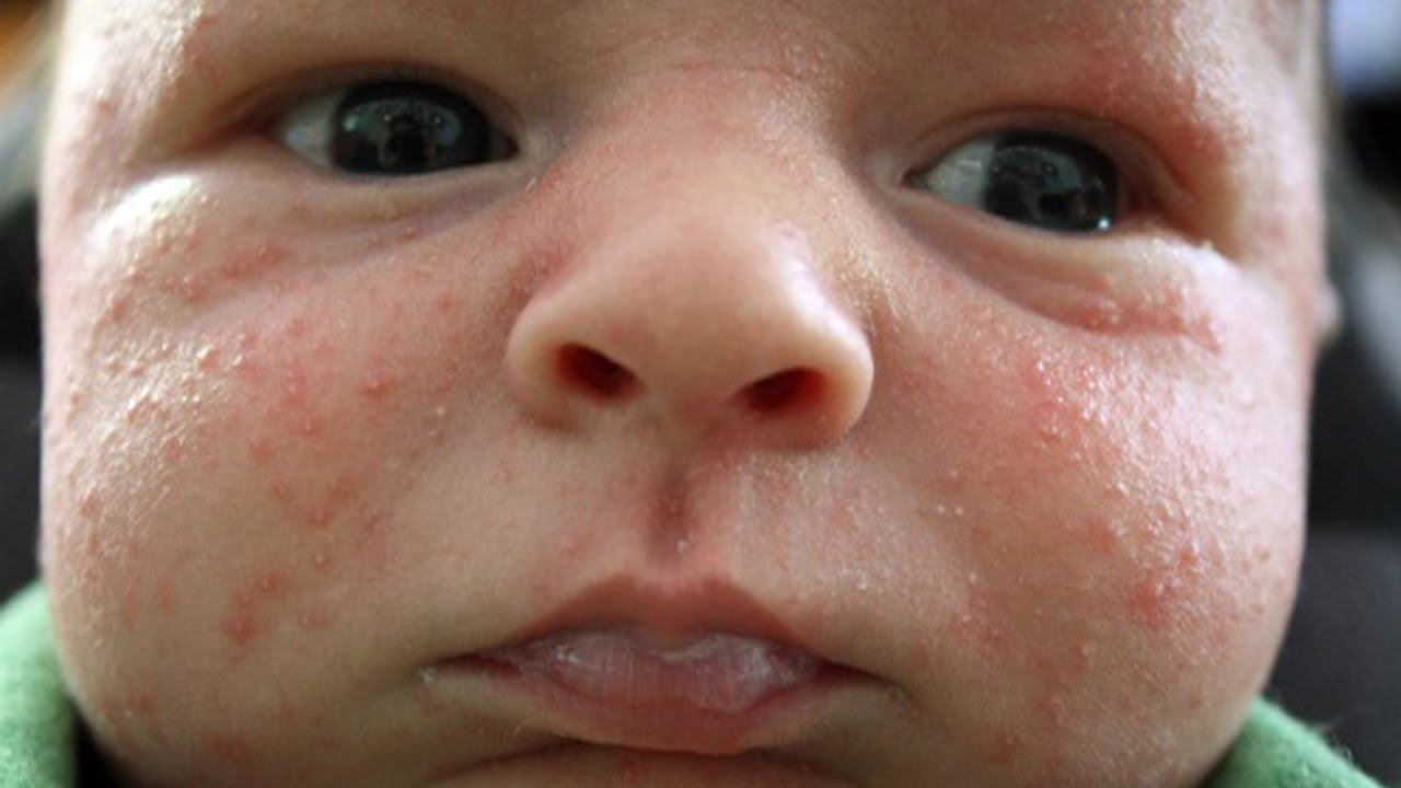 Hạt kê mọc khắp mặt của trẻ sơ sinh