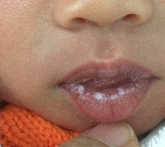 bé bị nấm miệng do dùng kháng sinh và corticoid dài ngày