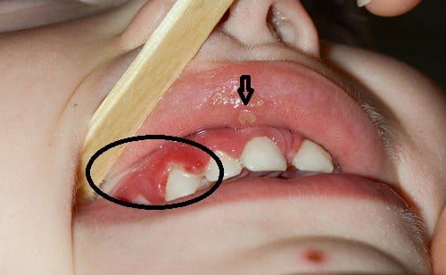 3 lý do trẻ bị viêm lợi và sâu răng mà mẹ vô hình giết hại con