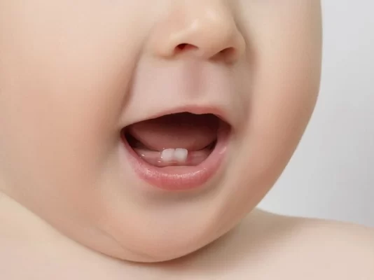 mọc răng sửa ở trẻ
