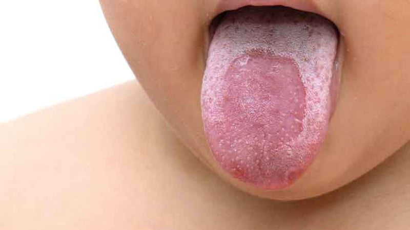 Nguyên nhân gây viêm lưỡi bản đồ ở trẻ em có liên quan tới di truyền, hệ thống miễn dịch