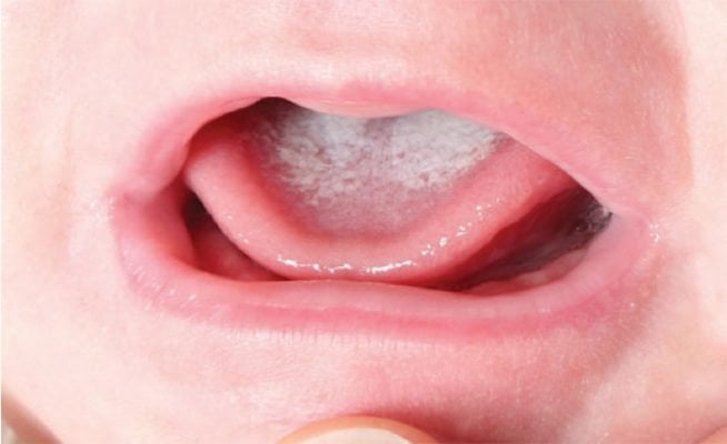 tưa lưỡi ở trẻ sơ sinh