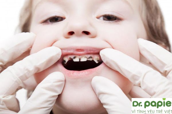 Sún răng ở trẻ nhỏ có nguy hiểm không?