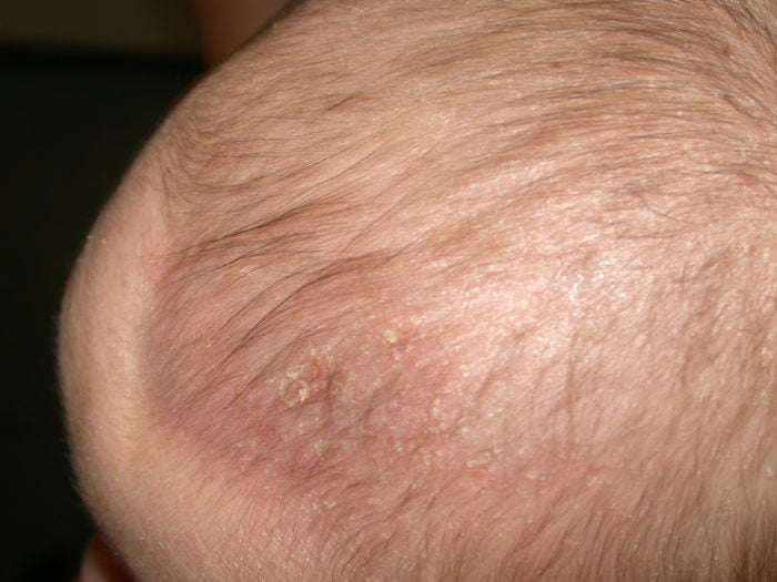 Trẻ bị "cứt trâu" đóng từng mảng trên da đầu