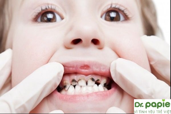 Sâu răng trẻ em – bố mẹ tuyệt đối không được xem nhẹ