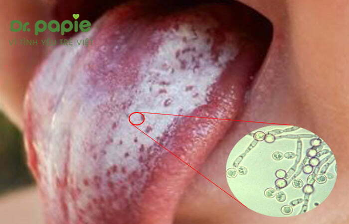 nấm Candida Albicans gây bệnh nấm lưỡi ở trẻ em