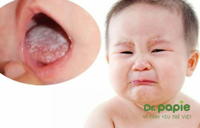 Nấm lưỡi khiến trẻ đau rát