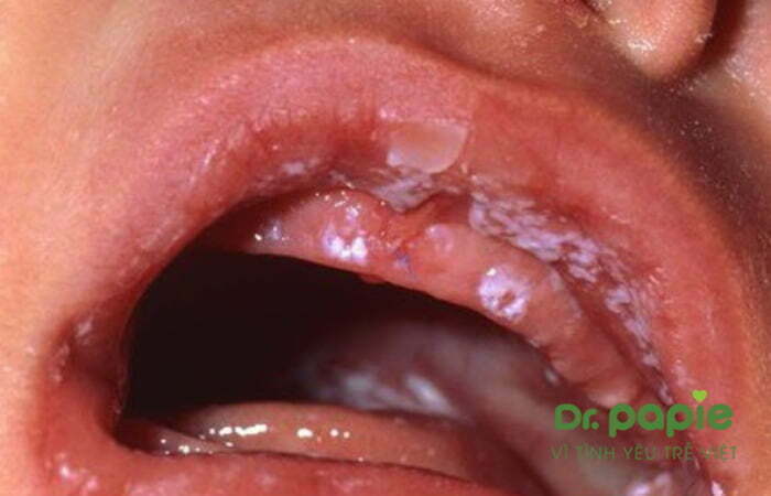 Trẻ bị nhiễm nấm toàn khoang miệng