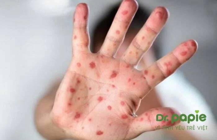 Bé bị nổi mẩn đỏ do sốt xuất huyết