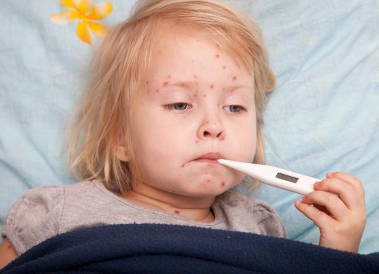 Một trong những triệu chứng sốt xuất huyết ở trẻ em là nổi ban đỏ