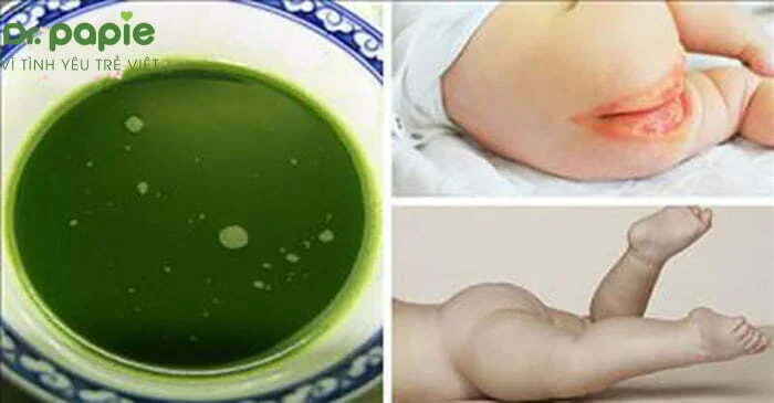 Trị hăm tã bằng lá khế