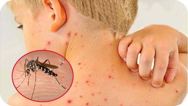 Trẻ bị sốt xuất huyết do muỗi truyền