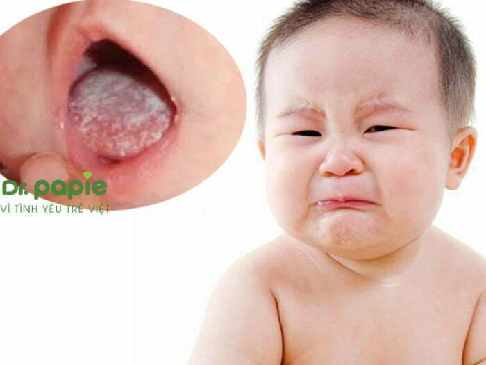 Nấm miệng ở trẻ sơ sinh trông như cặn sữa nhưng bám chắc và khó làm sạch