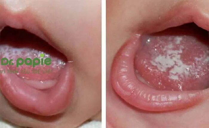 Nứt ở khóe miệng là một dấu hiệu nấm miệng ở trẻ sơ sinh nặng