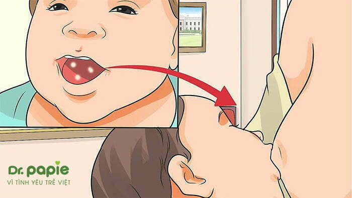 Nấm miệng ở trẻ em có thể lây sang mẹ khi mẹ cho con bú