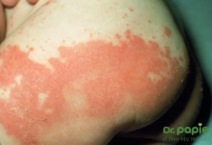 Khi nhiễm nấm Candida, vùng da của bé có mảng trắng hoặc đỏ và có biểu hiện viêm.
