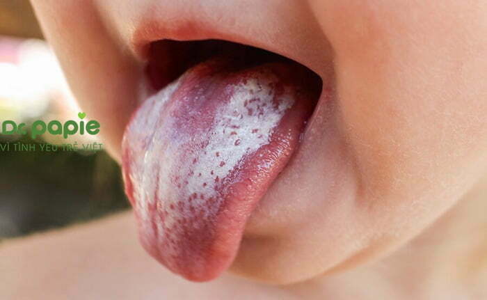 nấm miệng ở trẻ em có triệu chứng là các đốm trắng, mảng trắng 