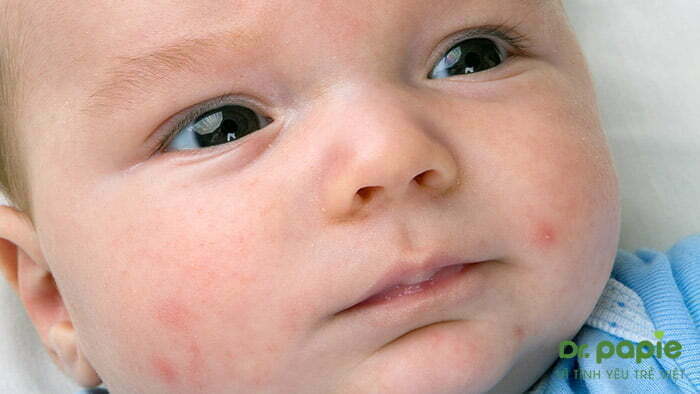 Trẻ bị sốt phát ban trên mặt