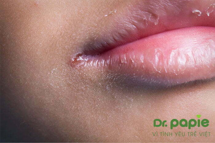 Hình ảnh nấm lưỡi ở trẻ em có nứt đỏ ở khóe miệng