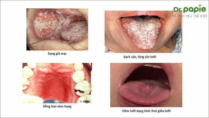 4 dạng nấm miệng ở trẻ em