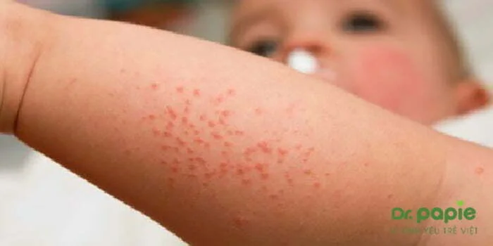 viêm da phát ban là một triệu chứng sốt siêu vi ở trẻ em