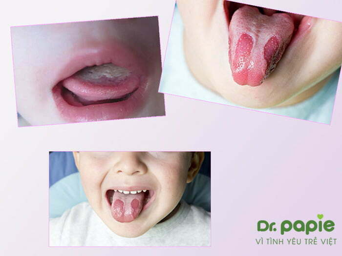11+ hình ảnh nấm lưỡi ở trẻ em giúp mẹ phát hiện bệnh sớm