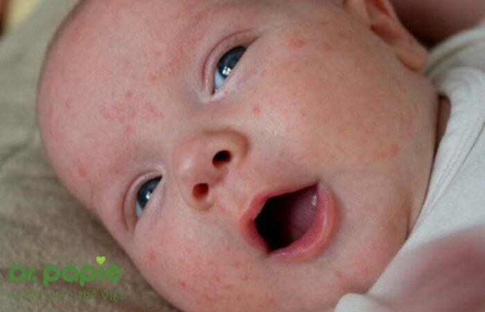 Trẻ bị sốt phát ban ở mặt với mụn nhỏ li ti