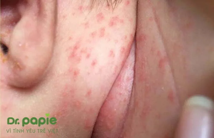 Bé bị chàm sữa ở cổ: Nguyên nhân, triệu chứng và cách điều trị 5 Ảnh vết loét ở cổ do chàm sữa
