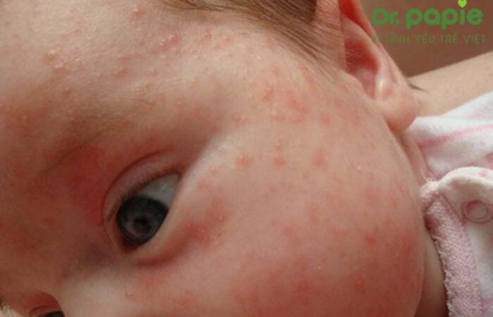 nốt phát ban nhỏ, mờ hoặc hồng nhạt trên mặt bé bị sốt phát ban