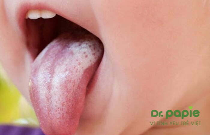 trẻ mắc bệnh tưa lưỡi 