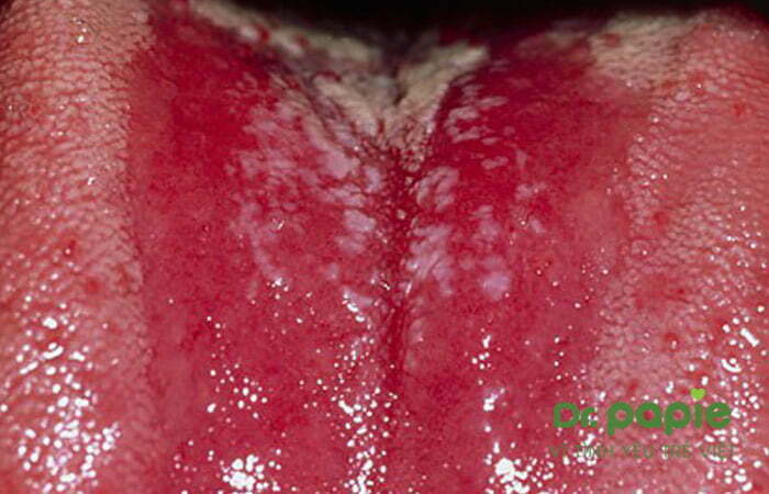 Lưỡi bé sơ sinh bị trắng cho bệnh Lichen phẳng vùng miệng