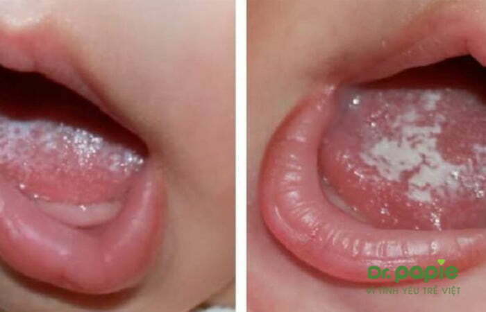 Nấm lưỡi ở trẻ em