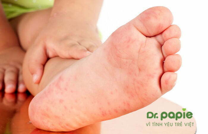 Hình ảnh phát ban ở chân trẻ bị sốt phát ban