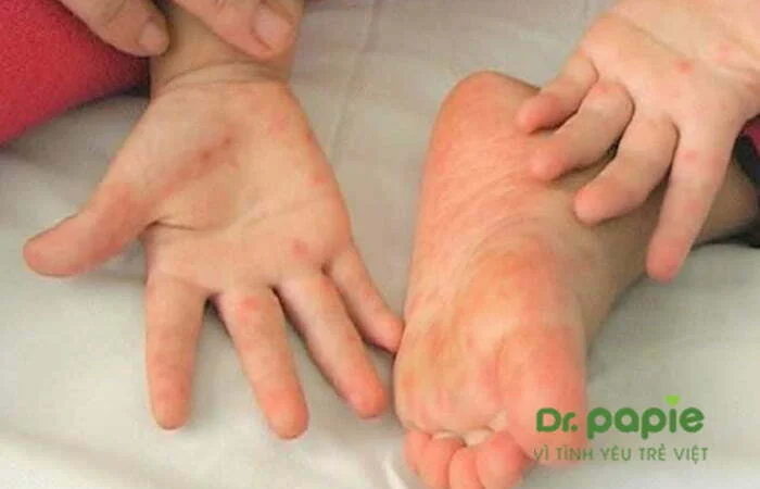 Hình ảnh Viêm da cơ địa cấp tính xảy ra ở tay, chân của bé