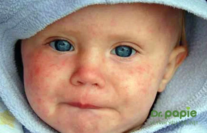 Trẻ bị nổi mẩn đỏ sau sốt