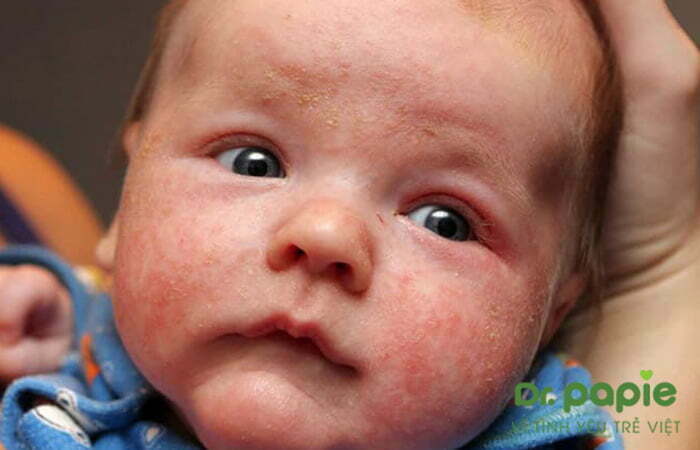 Trẻ bị viêm da cơ địa trên mặt