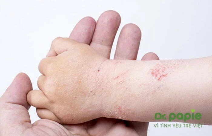 Hình ảnh Viêm da cơ địa cấp tính xảy ra ở tay của trẻ