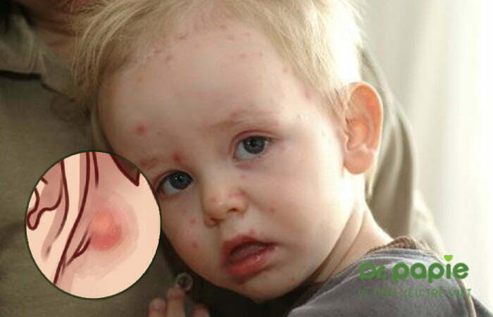 Trẻ sốt phát ban nổi hạch sau tai