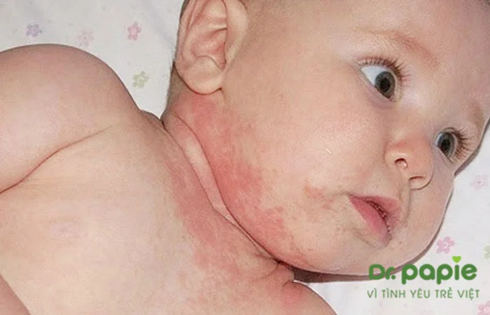 Bé bị chàm sữa ở cổ: Nguyên nhân, triệu chứng và cách điều trị 3 Ảnh cổ bé bị chàm sữa mẩn đỏ