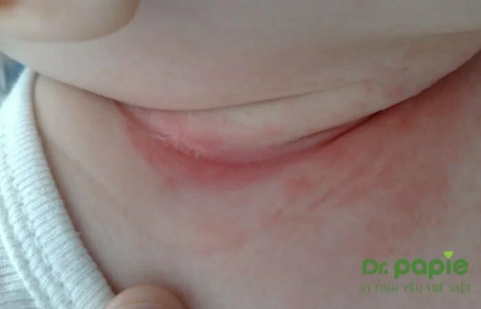 Bé bị chàm sữa ở cổ: Nguyên nhân, triệu chứng và cách điều trị 4 Ảnh mụn nước ở cổ bé bị chàm sữa