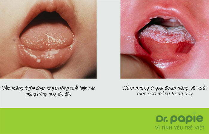 Nấm miệng ở trẻ em do Nấm Candida gây bệnh