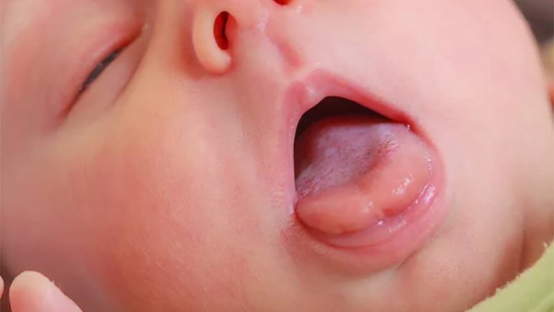 Rơ lưỡi cho bé thường xuyên giúp hạn chế tình trạng trắng lưỡi, tưa lưỡi