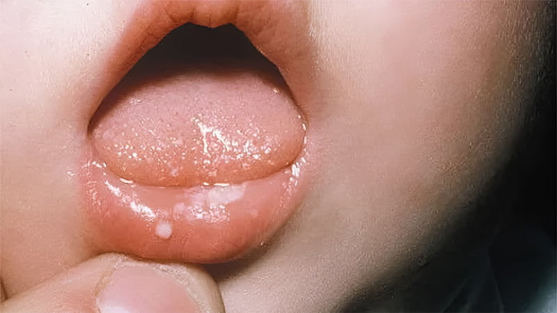 Nấm lưỡi (đẹn lưỡi) ở trẻ: nguyên nhân và cách điều trị hiệu quả
