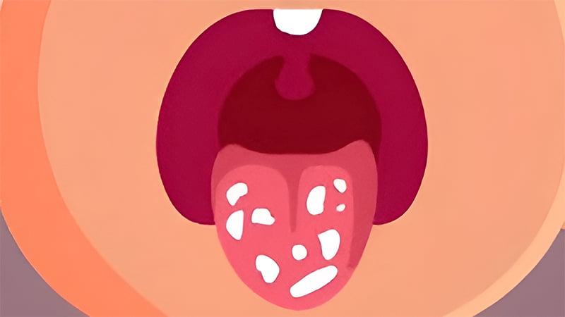 Nấm lưỡi (đẹn lưỡi) ở trẻ em là bệnh gì