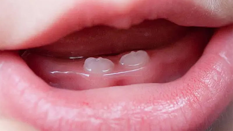 Trẻ mọc răng sớm tốt hay xấu