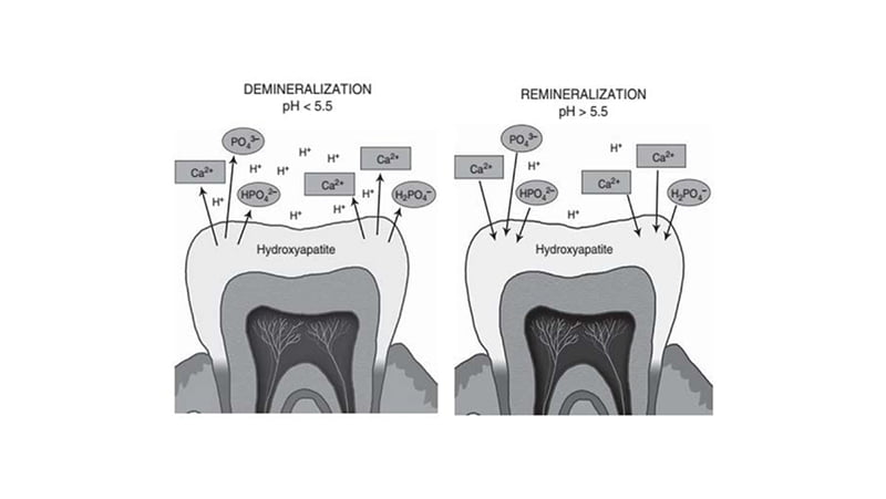 Cơ chế NaHCO3 chống lại sự mòn men răng gây ra bởi acid.