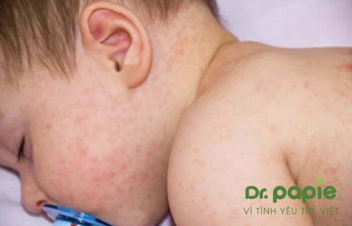 11+ thuốc điều trị sốt phát ban ở trẻ em an toàn theo từng độ tuổi Trẻ bị sốt phát ban