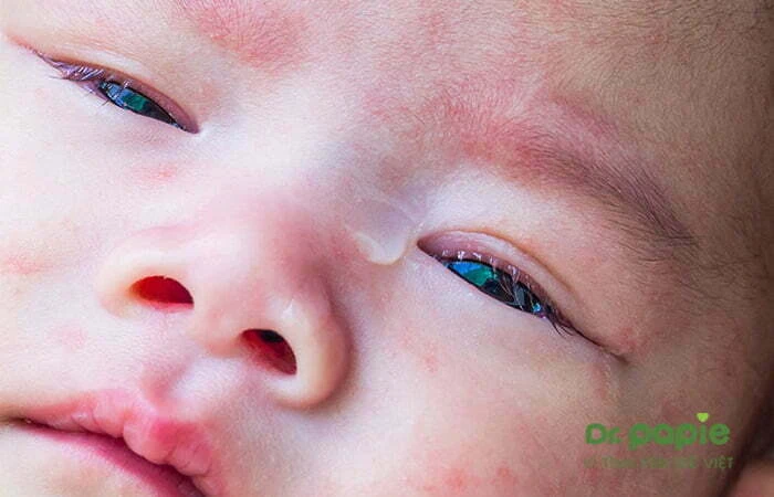 2 nguyên nhân trẻ sốt phát ban ngủ li bì và cách xử trí Trẻ sốt phát ban