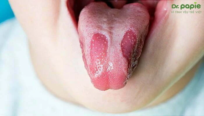 5 cach tri trang luoi o tre so sinh an toan hieu qua tai nha 1